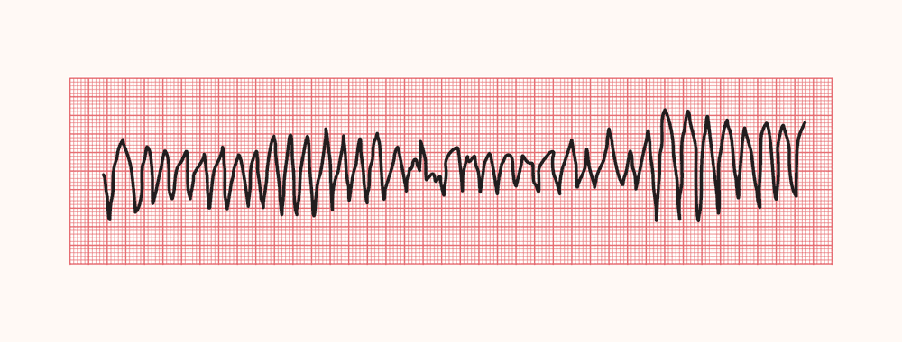 torsades ecg