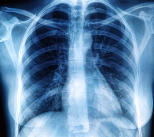 derrame pleural