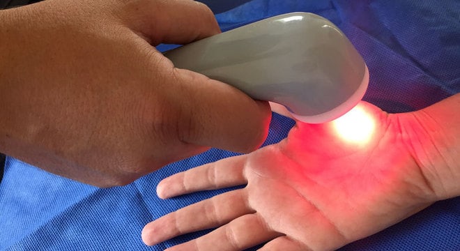fibromialgia