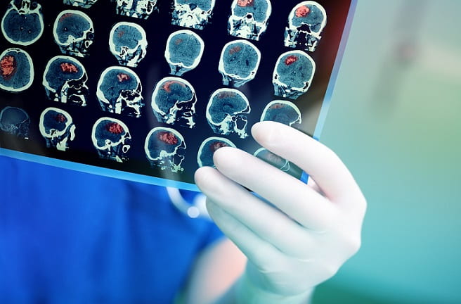 médico avaliando ressonância de crânio de paciente com TCE e avaliando uso do ácido tranexâmico