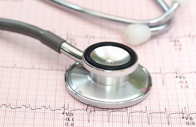 eletrocardiograma apresentando repolarização precoce com um estetoscópio em cima