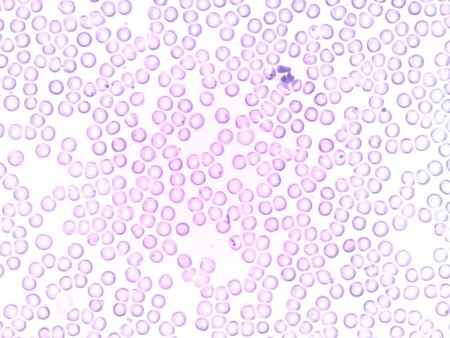 Imagem microscópica de leucócitos do sangue de uma paciente infectado pelo novo coronavírus.