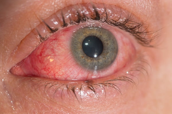 Paciente com síndrome oculoglandular de Parinaud