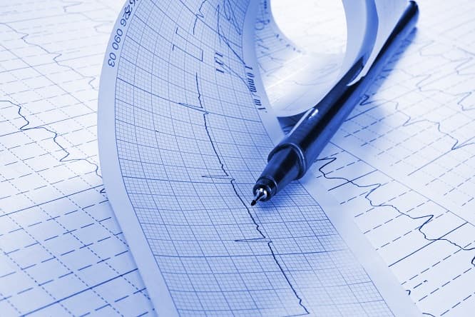 eletrocardiograma de paciente com síndrome coronariana sem supra de ST