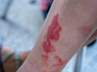 Revisão sobre dermatite atópica