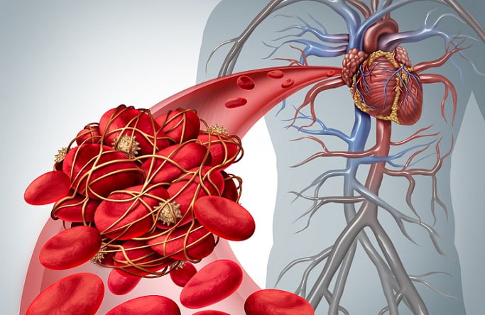 imagem digital de tromboembolismo pulmonar