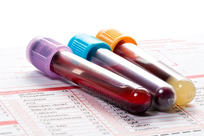 vidrinhos de sangue para exame de ácido úrico