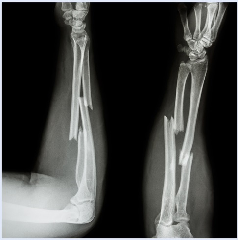 Fixação de 1 ou 2 ossos do antebraço nas fraturas pediátricas diafisárias de rádio e ulna?