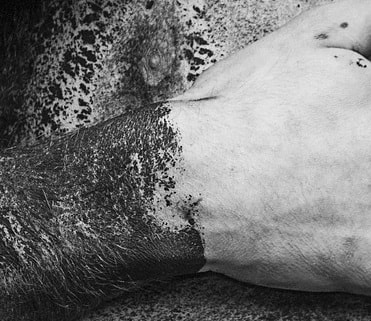 Creme de ruxolitinibe uma nova esperança para o vitiligo