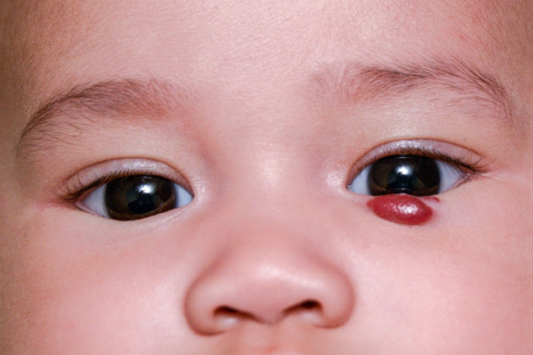 hemangioma-capilar