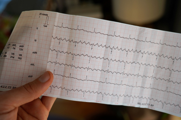 fibrilação-atrial